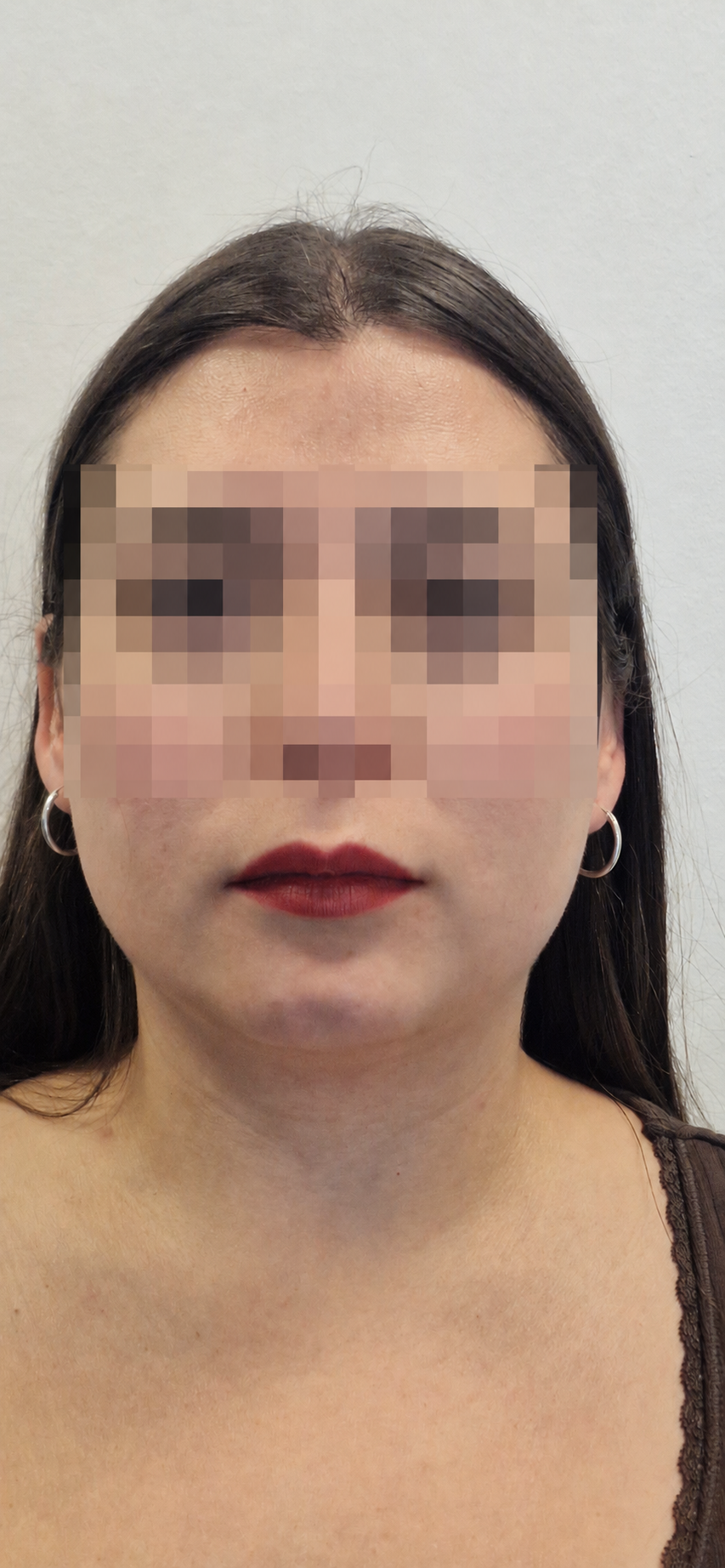 Antes de tratamiento de mentón con ácido hialurónico, identidad anonimizada